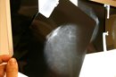 Un estudio español concluye que el análisis del genoma permitiría predecir en qué pacientes tratadas con un anticuerpo conocido como Herceptin el cáncer de mama va a progresar más lentamente. EFE/Archivo