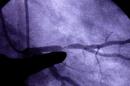 En esta imagen del 24 de junio de 2002, un doctor apunta hacia una arteria coronaria con un bloqueo de entre 80 y 90% en Saint Louis. Un estudio publicado en el New England Journal of Medicine el miércoles 8 de abril de 2015, revela que los genes que gobiernan la estatura también parecen afectar el colesterol, especialmente en hombres. (Foto AP/Tom Gannam)