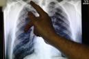 Pese al progreso, la tuberculosis persiste en ciudades del oeste de Europa
