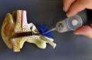 Asocian la osteoporosis con un aumento del riesgo de sordera súbita