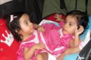 Fotografía de las niñas siamesas conocidas como "Las Rositas", en Guatemala. EFE