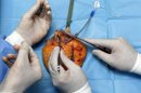 Un tratamiento inédito con células madre cardiacas ha logrado una regeneración parcial del corazón de una veintena de pacientes de infarto. EFE/Archivo