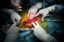 Varios cirujanos trabajan en una operación de transplante de riñón de un donante vivo en el hospital universitario Semmelweis de Budapest (Hungría). EFE/Archivo